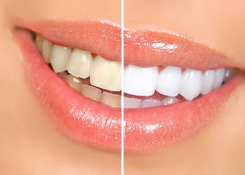 آیا سفید کردن دندان‌ها با کیت‌های سفیدکننده مضر است؟